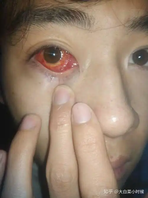 斜视手术是一种怎样的体验