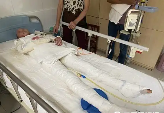 求助安康11岁女孩玩甲醇不慎烧伤全身仍想跳舞当舞蹈家