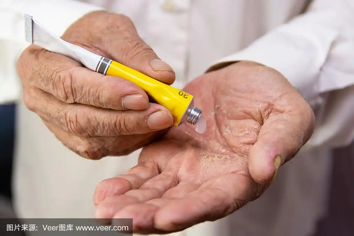 老人手上的药膏.使用软膏和润肤乳霜来治疗和滋润皮肤.老年皮肤问题