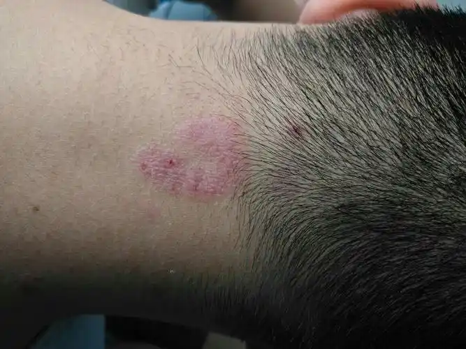 头颈部有这种事皮癣吗,怎么治?