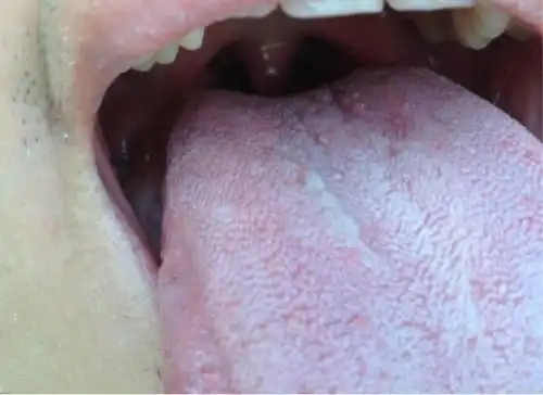 舌头上长了好多小红肉疙瘩,是怎么回事?求专业回答