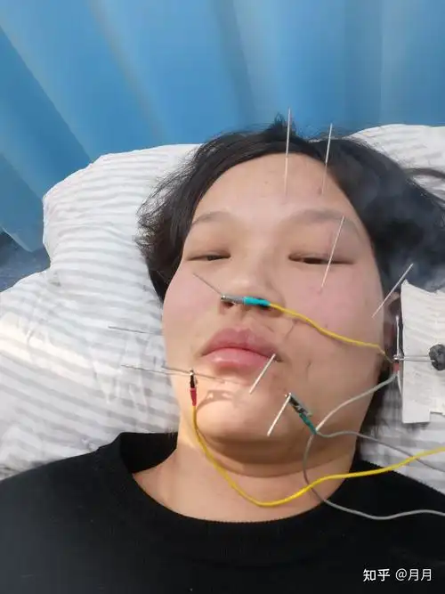 哺乳期面瘫治疗过程