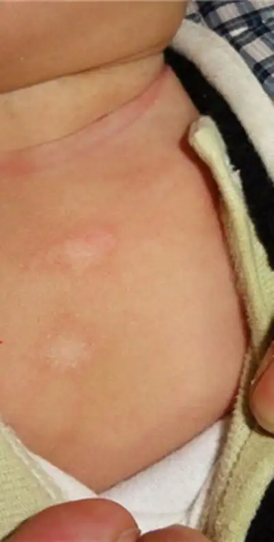 重庆花斑癣医院_重庆治疗花斑癣哪家医院好_重庆治疗花