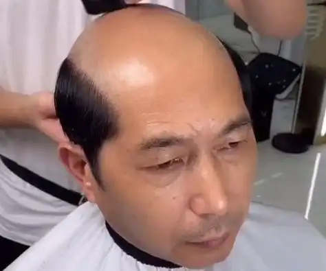 地中海发型是指中间没有头发,秃顶,四周有头发,常见于男性.2.