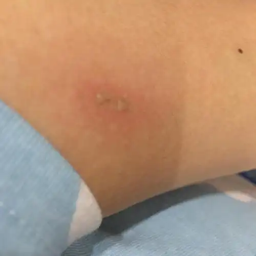 感觉应该是两个牙齿的某种植物,而且起水泡了,红肿痛痒 不知道是啥咬