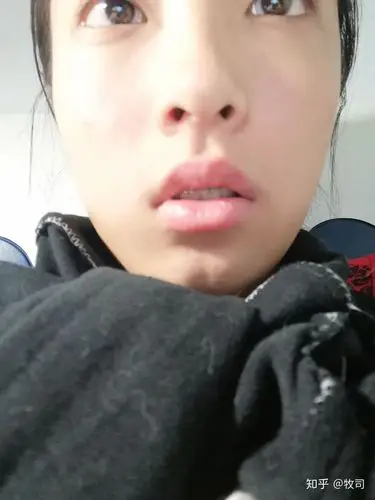 22岁,刚刚摘了牙套,觉得牙齿中线偏移很多,上下牙中线都偏很多,照镜子