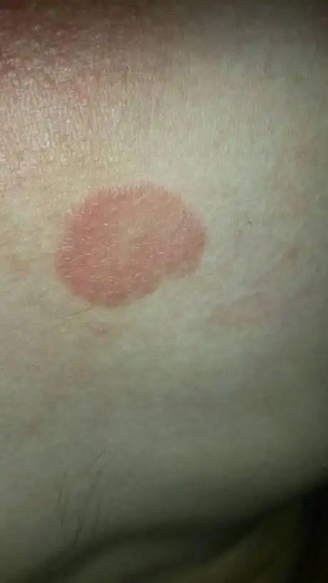 胸前长了好像胎记似的红斑,以前没有,这两年才发现的.