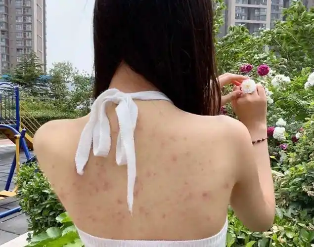 后背出油还总冒痘?过来人3个方法!痘痘粉刺和闭口瞬间断根!