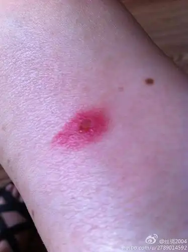 大概是被毒蚊子叮咬的,又痒又疼,皮肤红的吓人,阿有啥好办法啊?