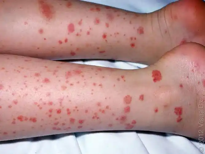 宝宝感冒或者疫苗后全身出现出血点紫癜是什么问题怎么办