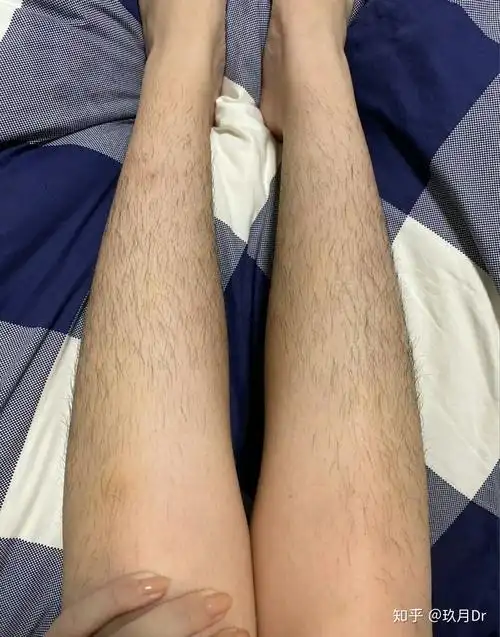 女孩子长腿毛怎么办?