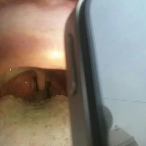 嗓子两侧的肉肉上有小眼,不知道是什么?舌头根部还有豆?