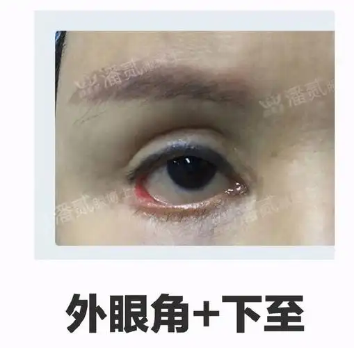 开外眼角和下至后遗症:下三白眼,结膜外露,不适,影响眼部健康|手术|黑