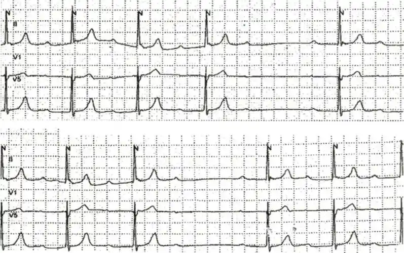 图2-16 二度Ⅱ型房室传导阻滞
