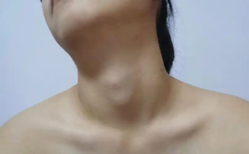 女生长喉结怎么办是因为太瘦了还是激素分泌不正常