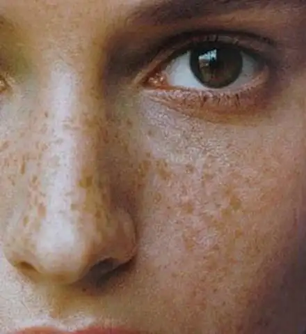 黄褐斑形成有哪些原因_黄褐斑原因_大成皮肤网