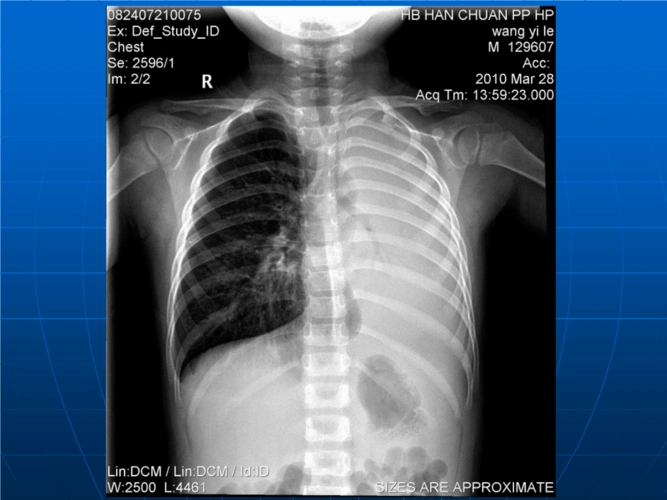 肺不张诊断及鉴别ppt课件ppt13页