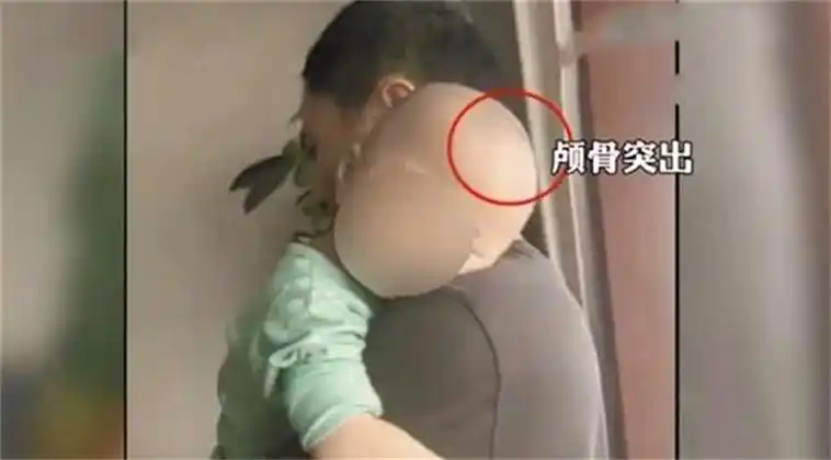 三鹿奶粉造成的危害三鹿奶粉大头娃娃现状