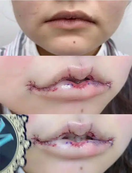 微笑唇前后对比vs可爱～减龄～性感,要漂亮到所有人