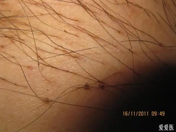 看图识病--------阴虱