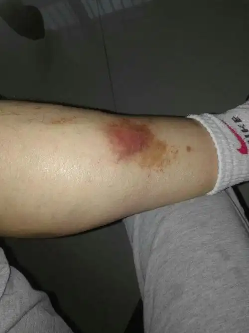 糖尿病小腿肚子发紫色斑块,严重吗,怎么治疗,谢谢!