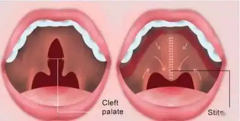 腭裂是指患儿口腔里的上腭部(俗称天堂或上堂)出现裂隙.