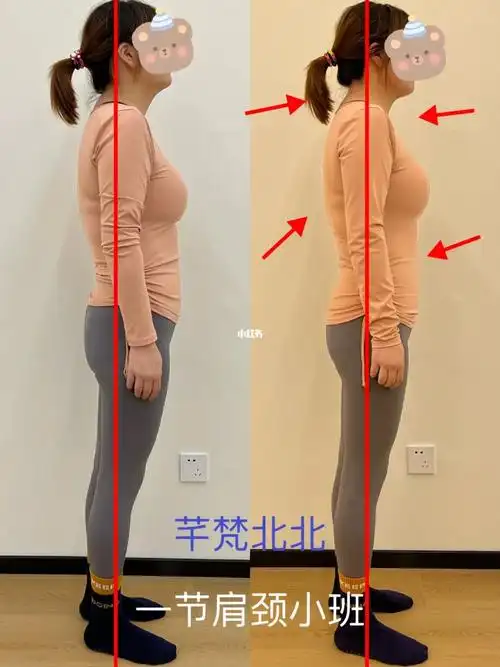 改善肩颈疼痛  #头前引 #肋骨外翻 #圆肩驼背 #翼状肩胛 #肩胛骨