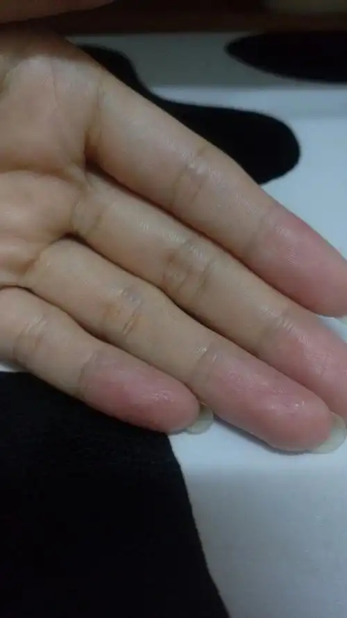 每次转季,手指都会长水泡,这是什么问题,而且会传染,旁边的手指都会有