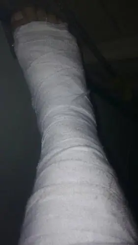 在工作中腿受伤了,导致骨折,怎么样来要赔偿金,大家知道不