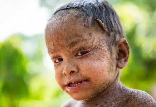 世界最小的"穿山甲人",全身布满蜥蜴状鳞片