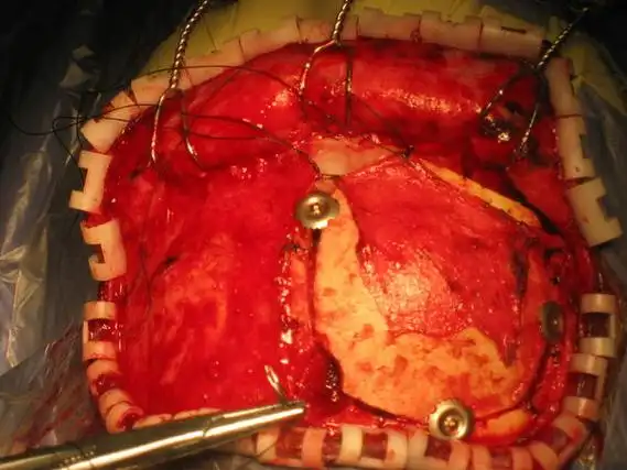 开颅手术不可怕