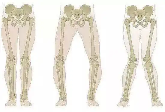 医生解析:八字步通常会影响孩子身高和骨骼发育,内八字 ,x型腿 ,拇