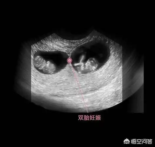 如果是异卵双胞胎,因为它有两个胎囊,需要等胚胎出现胎心和胎芽,也就