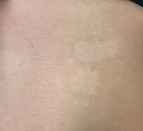 03039 次咨询皮小徐医生你瞧,她的白斑长得是这个样子:毕竟夏天不能再