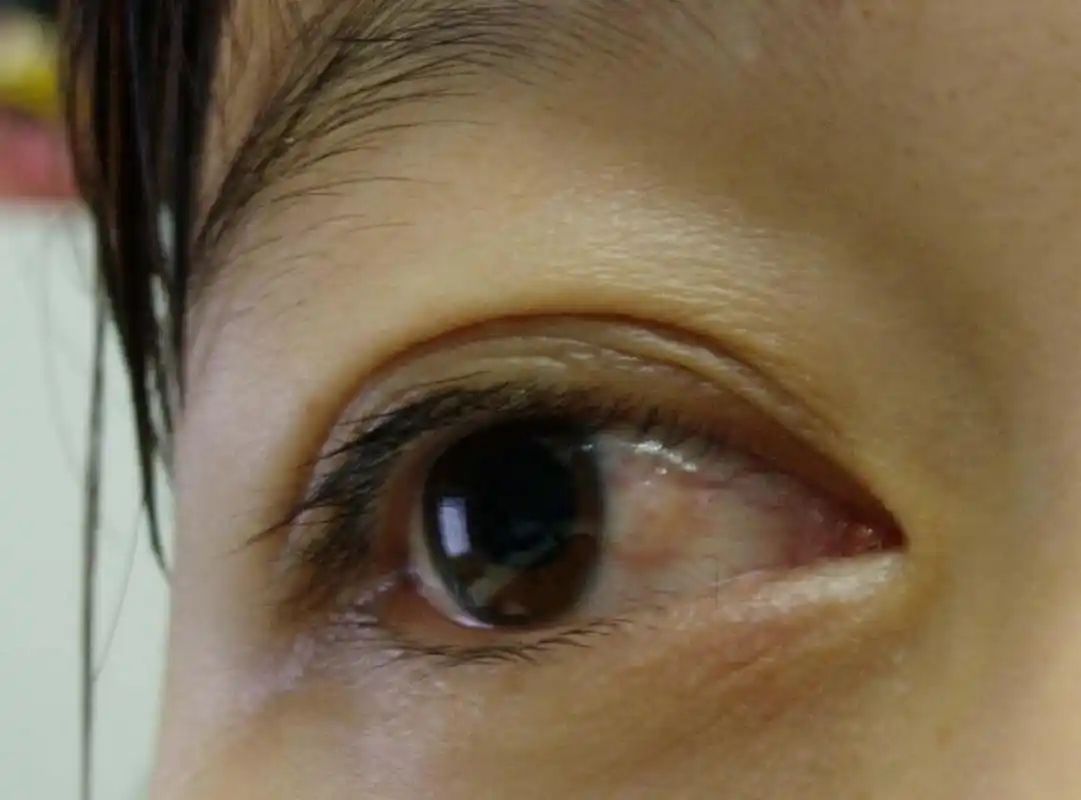 长在眼睛里的"息肉" 近日,一位38岁的秋女士来到了华山眼科医院求诊