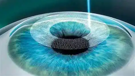 是包括视力,电脑验光,角膜地形图,光学生物测量,干眼检查,散瞳验光