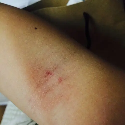 不知道的情况下胳膊内侧弯肘的地方出现红点中小块有时会周围发红