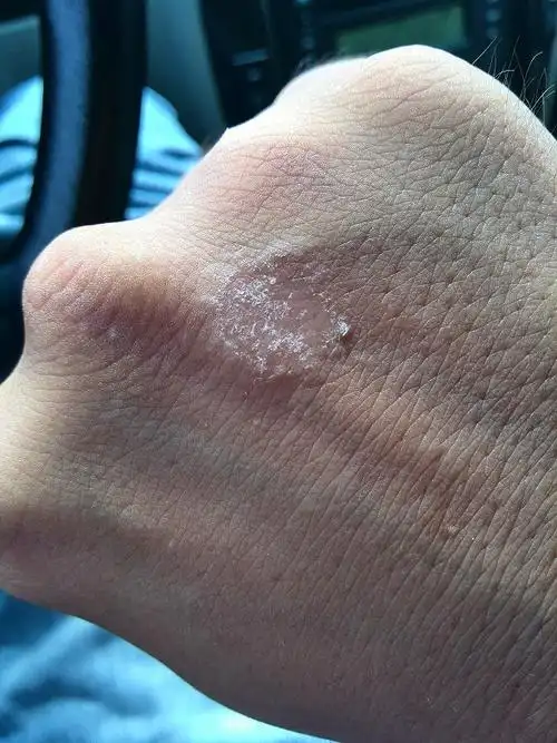 手背皮肤一小块起皮