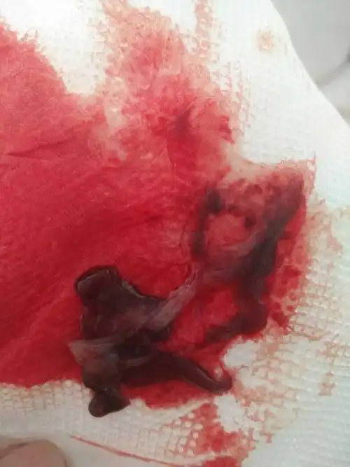 下月准备做促排卵,刚来月经第3天医生让吃一盒妈富隆,今早就流了这样