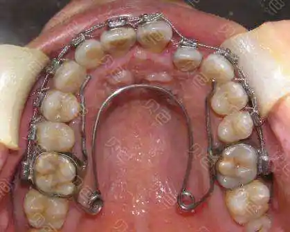 听说牙齿扩弓矫正后的效果会更好!