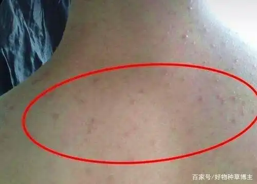 螨虫到底有多可怕?不定期除螨的人如今怎么样,皮肤专家说出实情