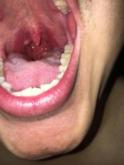 长个疙瘩也有这么多的学问