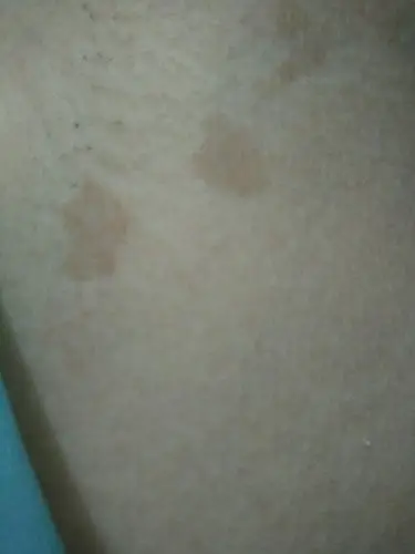 腋下长了褐色斑点,去年有一点点,今年就很明显,没有感觉痒或者不舒服.