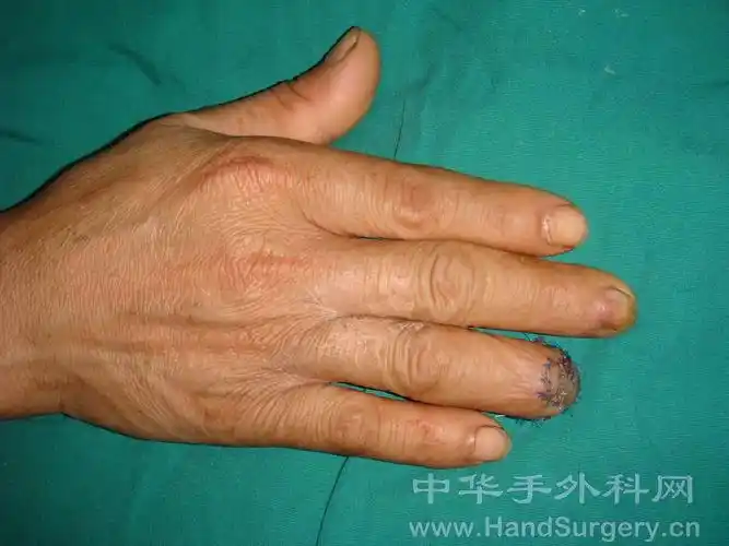v-y推进皮瓣蒂部植皮修复指尖缺损(更新术后5.5个月)