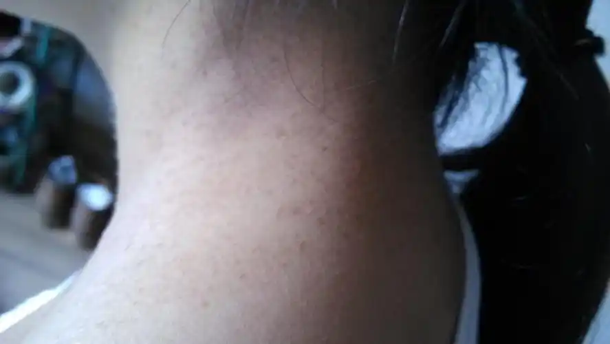 颈部长的是什么斑