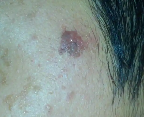 脸上黑色素瘤早期症状图片