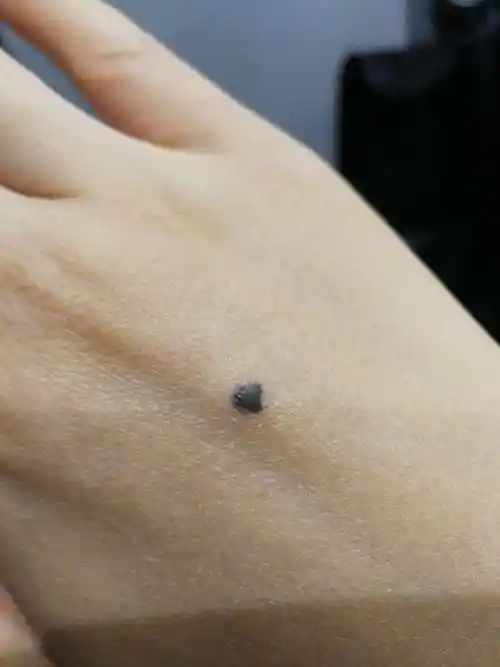 你好这就是色素痣,一般都是良性的,可不用处理,观察即可部分信息和