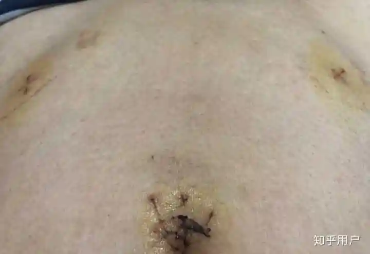 做腹腔镜精索静脉曲张高位结扎术是种什么体验?