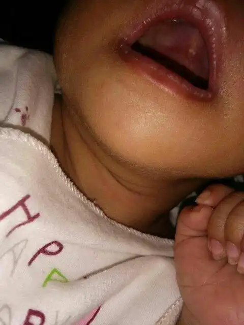 月子中的宝宝上颚长了个东西,像奶瓣一样白白的,是什么?