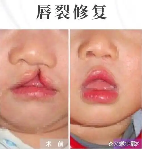 兔唇是一种常见的唇裂畸形,通常是出生时唇部发育不完全或者发育